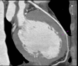 Plaque LAD - CTisus CT Scan