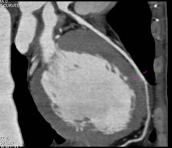 Plaque LAD - CTisus CT Scan