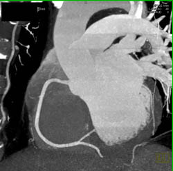 Normal RCA - CTisus CT Scan