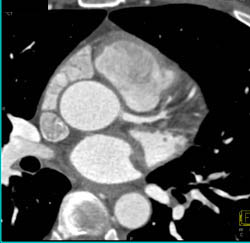 Plaque LAD - CTisus CT Scan