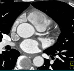 Plaque LAD - CTisus CT Scan