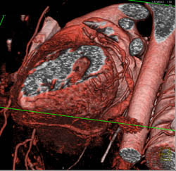 Path of Circumflex Coronary Artery - CTisus CT Scan