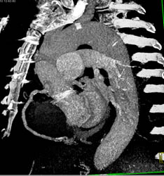 Plaque in RCA - CTisus CT Scan