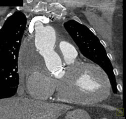 Root Repair With Post Op Changes - CTisus CT Scan