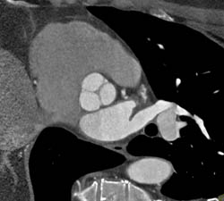 Normal Aortic Valve - CTisus CT Scan