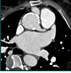 Calcified Aortic Root With Dilated RCA - CTisus CT Scan