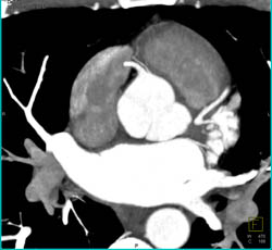 Av Nodal Branch Off Right Cusp - CTisus CT Scan