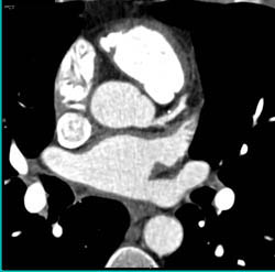 Plaque in LAD - CTisus CT Scan