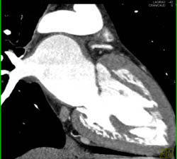 Plaque in LAD - CTisus CT Scan