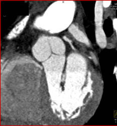 Plaque in LAD - CTisus CT Scan