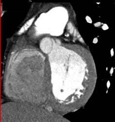 Plaque in LAD - CTisus CT Scan