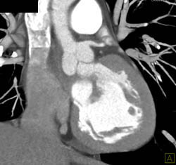 Plaque in LAD - CTisus CT Scan