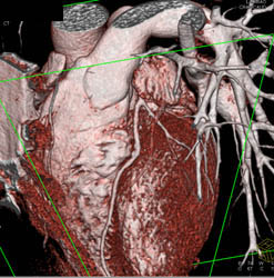 Plaque in LAD - CTisus CT Scan