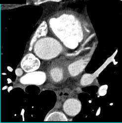 Plaque in LAD - CTisus CT Scan