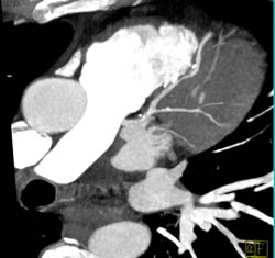 Plaque in LAD - CTisus CT Scan