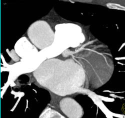 Plaque in LAD - CTisus CT Scan