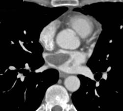 Metastatic Chondrosarcoma to the Pulmonary Vein and Left Atrium - CTisus CT Scan