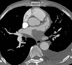 Lung Cancer Invades Pulmonary Vein and Extends Into the Left Atrium - CTisus CT Scan