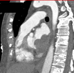 Metastases to Spine and Left Atrium From Sarcoma - CTisus CT Scan