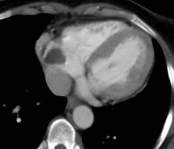 Thrombus in Right Atrium Due to Indwelling Catheter - CTisus CT Scan