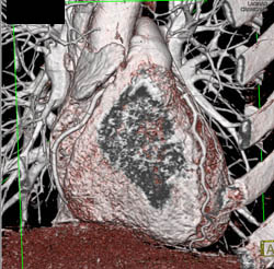 3D of RCA - CTisus CT Scan