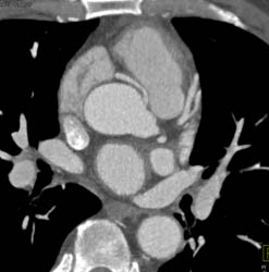 Aberrant RCA Off Left Cusp - CTisus CT Scan