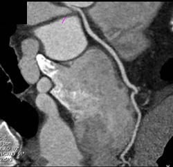 Normal LAD - CTisus CT Scan