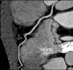 Normal LAD - CTisus CT Scan