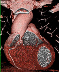 Normal RCA - CTisus CT Scan