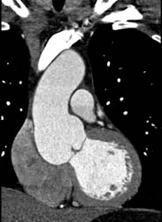 Normal RCA - CTisus CT Scan