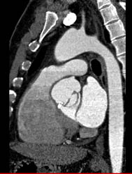 Normal RCA - CTisus CT Scan