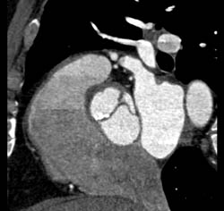 Normal RCA - CTisus CT Scan