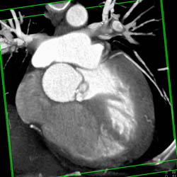 Normal RCA - CTisus CT Scan