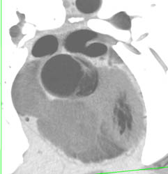 Aortic Stenosis With Dilated Aortic Root - CTisus CT Scan