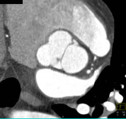 Bicuspid Valve - CTisus CT Scan