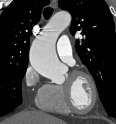 Bicuspid Valve - CTisus CT Scan