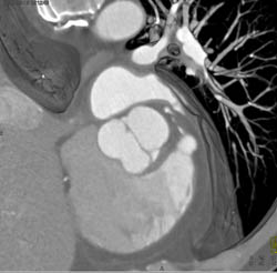 Bicuspid Valve - CTisus CT Scan