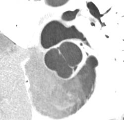 Bicuspid Valve - CTisus CT Scan