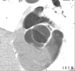 Bicuspid Valve - CTisus CT Scan