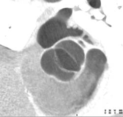 Open and Closed Bicuspid Valve - CTisus CT Scan