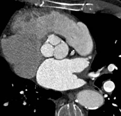 Calcified Leaflets of Aortic Valves - CTisus CT Scan