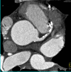 LAD Calcified and Non Calcified Plaque - CTisus CT Scan