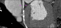 LAD Stenosis - CTisus CT Scan