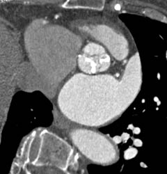 Calcified Aortic Valve With Aortic Stenosis - CTisus CT Scan