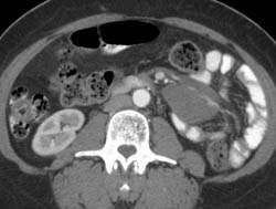 Lymphoma in Small ???? and Atrium - CTisus CT Scan