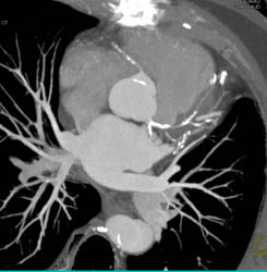 LAD Disease With Bypass - CTisus CT Scan