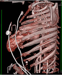 Pentology of Fallot - CTisus CT Scan