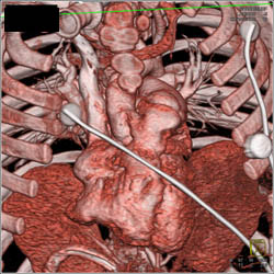 Enlarged Thymus - CTisus CT Scan