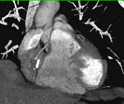 Step Off Due to PVC - CTisus CT Scan