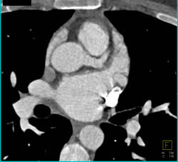 Circumflex Aneurysm and Persistent Left Superior Vena Cava (SVC) - CTisus CT Scan